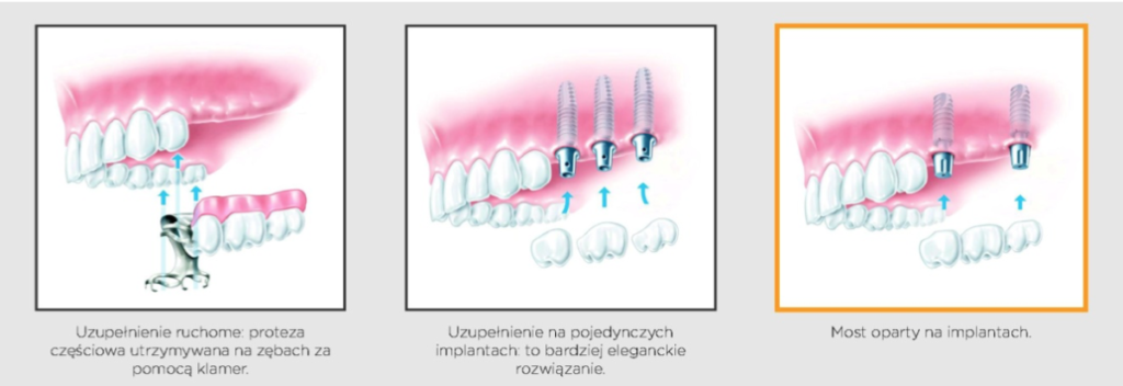 Implant w przypadku braku kilku zębów 2 8 1024x352 1