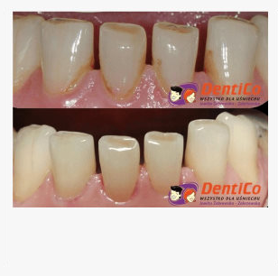 Gabinet higieny - Efekty leczenia Dentico gabinet higieny przed po 3