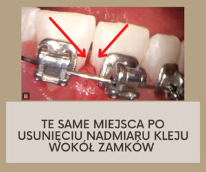 Technologia oczyszczania zębów photo4 1